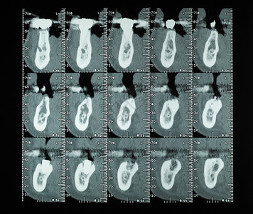CT扫描akaCAT扫描横切截面摄影图象X图片
