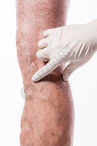 医生用堵塞的静脉血栓症脑膜炎检查人体腿图片
