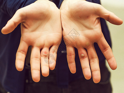 男手掌手指受损皮肤上有痛苦的不健康水图片