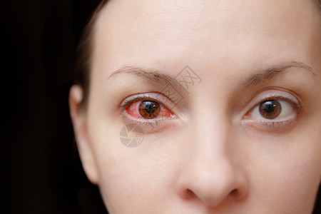 关闭受结膜炎或流感冒或过敏影响的女一只恼怒的红血和健康眼睛疾病和治疗的概念复制广告空间背景图片