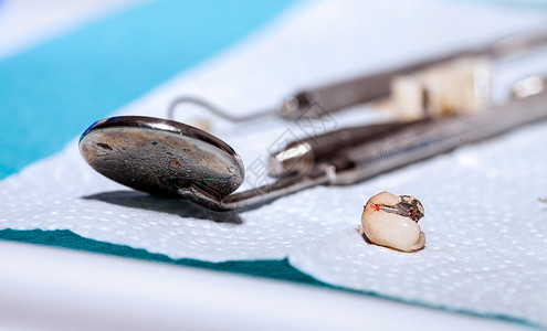 超薄瓷贴面牙医的牙齿瓷修复体背景