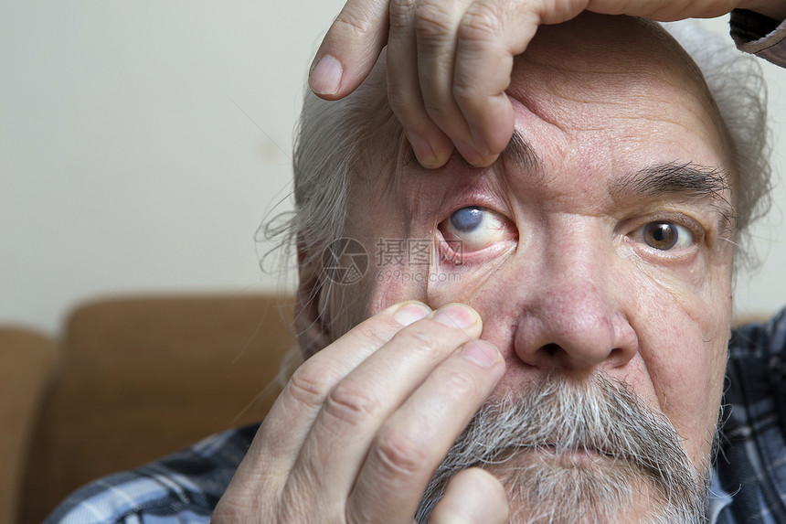 眼科检查中老年白内障的检查u老年人白内障和青光图片