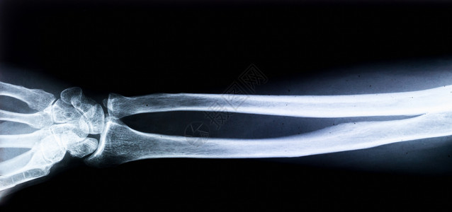 人体手臂X光片图片