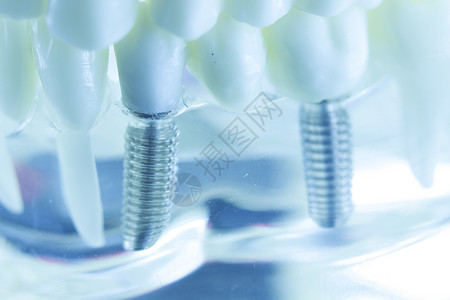 牙科钛美学正畸牙种植体在牙医口腔牙齿模图片