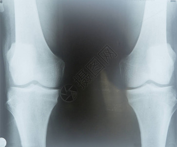 一位老人膝关节的X光照片图片