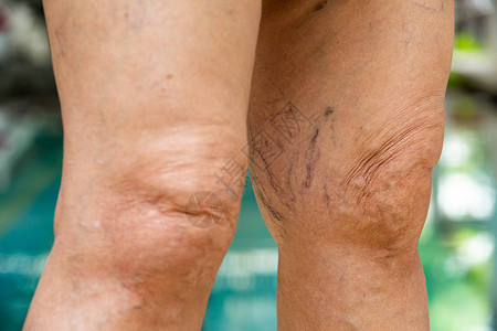 老年妇女膝盖和腿后部的静脉曲张图片