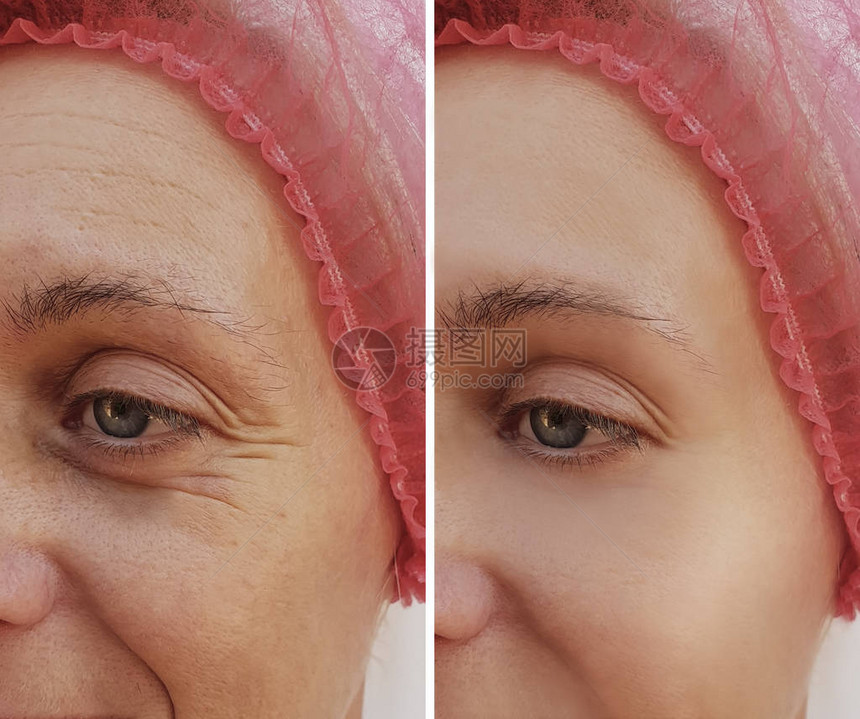 在抗老年手术前后妇女脸上的图片