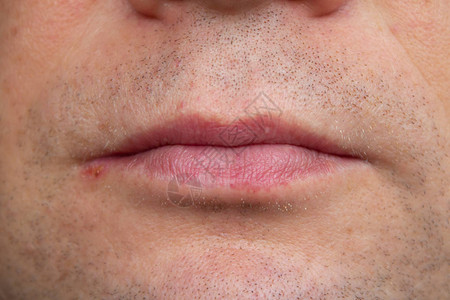 人嘴唇感染疱疹特写男人脸图片