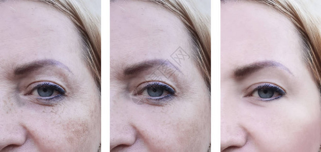 女人的眼部在手术前后都长图片