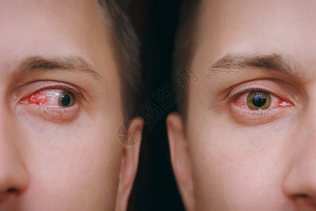 关闭受结膜炎或流感冒过敏影响的恼怒的红血人类男眼睛一边看相机疾病治疗医学健康理念复制空间工背景图片