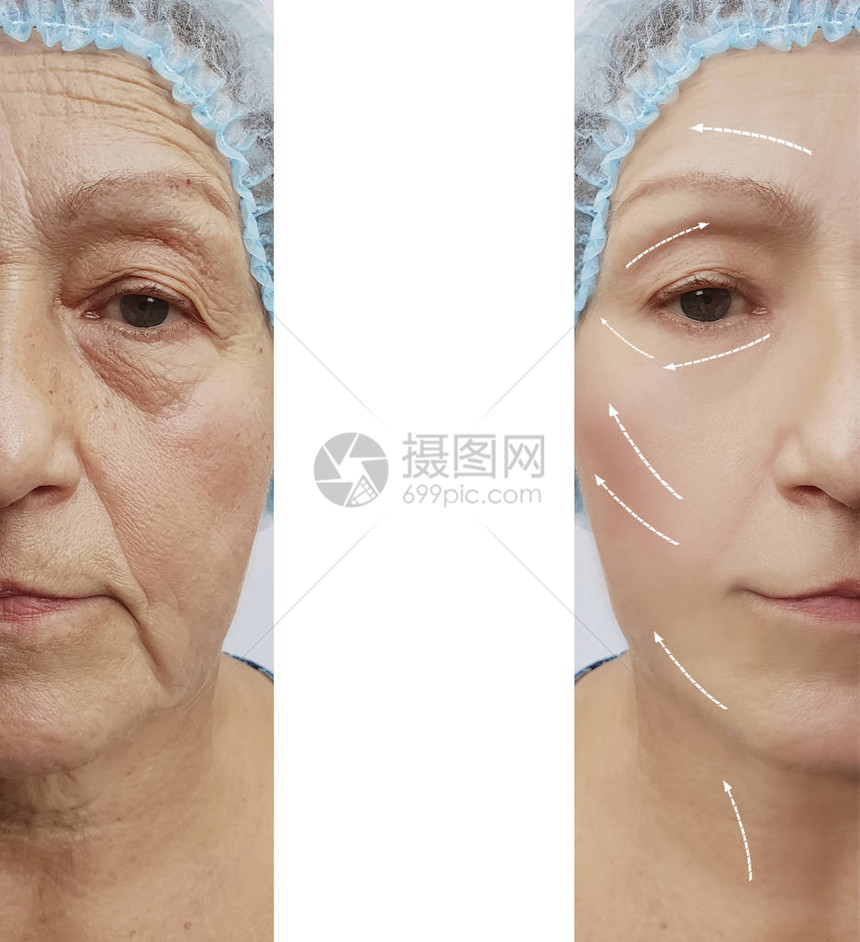 一个老妇人的面部在手术前后图片