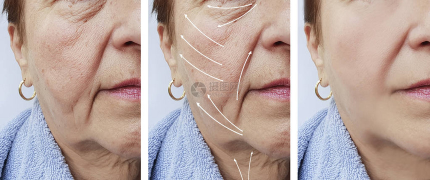 长老年妇女面部皱纹在手术前后和手术前图片