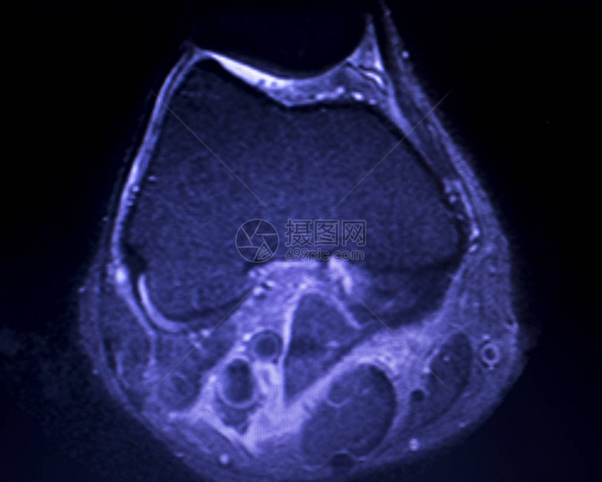 磁共振成像MRI膝盖后部角中枢断裂的眼泪