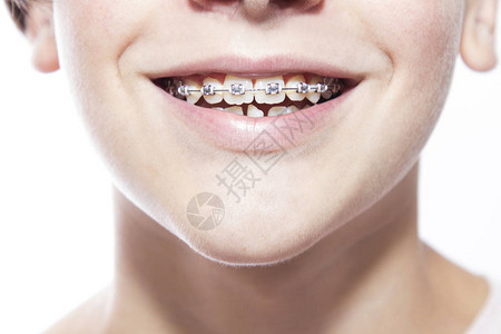 用牙齿矫正器或牙套特写嘴巴图片