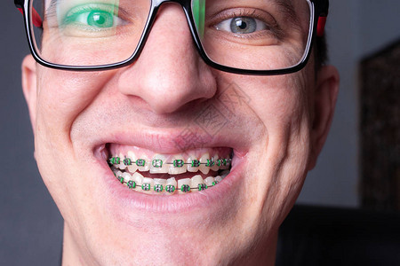 牙齿上的护带和括号医生对牙图片