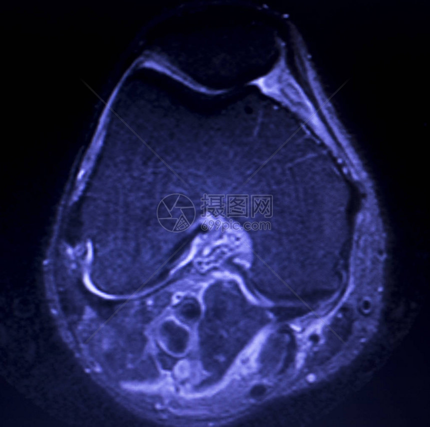 磁共振成像MRI膝盖后部角中枢断裂的眼泪图片