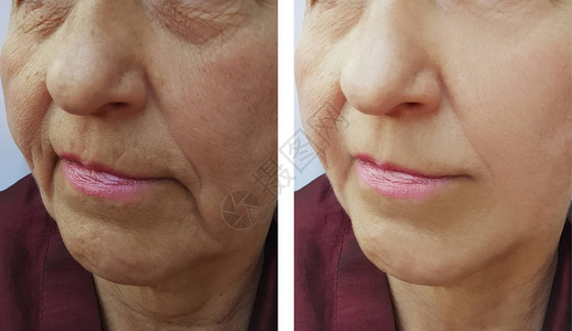 手术前后老妇人脸上的皱纹图片