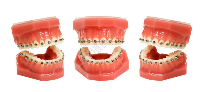 牙齿模型装有金属带铁丝的牙套的下巴图片