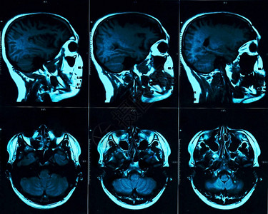 用头骨对大脑进行磁共振扫描图片