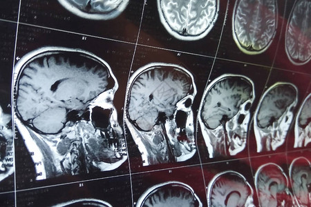 用头骨对大脑进行磁共振扫描图片