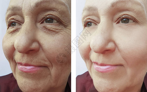 在程序前后老年妇女的脸部皱纹在手术前图片