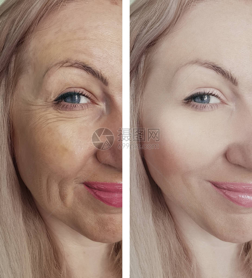 女人在治疗前后脸上的皱纹图片