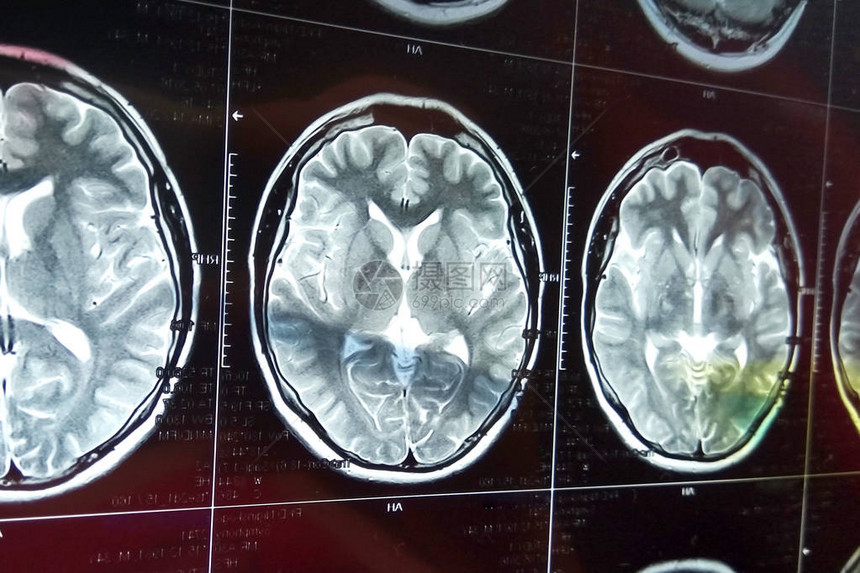 用头骨对大脑进行磁共振扫描MRI在暗底背景上做头部扫描X射线药图片