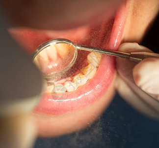 牙科治疗中的牙科治疗工图片
