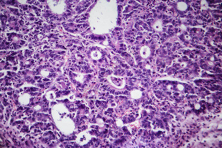 胃腺癌光学显微照片显微镜下的照片图片