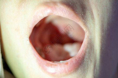 口腔内喉咙痛特写视图体检咽和扁桃体喉咙里有红色水泡喉咙舌图片