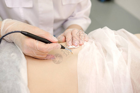 显微外科从女患者的胃中去除胎记的医学治疗女皮肤科医生使用电烙术去除腹部痣无线电背景