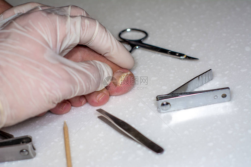 孤立在白色背景上的甲剥离戴手套的医生的手检查指甲的损伤指甲板的机械损伤使用虫胶或凝胶清漆图片