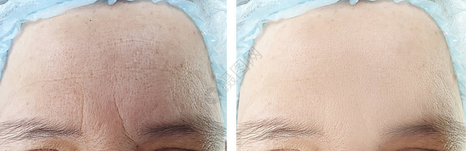 在程序前后老年妇女的脸部皱纹在手术前图片