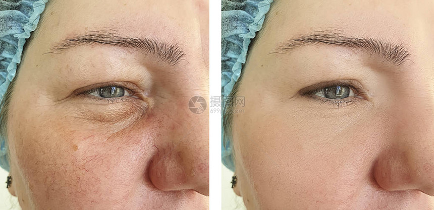 女人在手术前后脸上的皱纹酒渣鼻图片