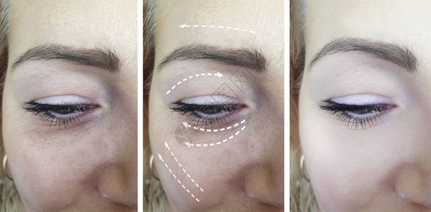 女人在治疗前后脸上的皱纹图片