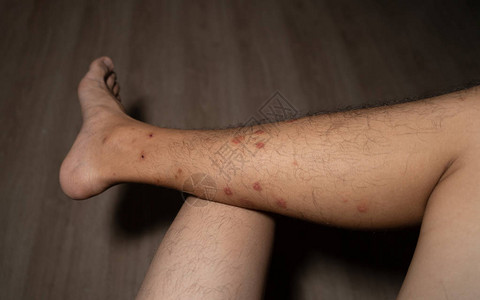 关闭对昆虫蚊子或昆虫叮咬过敏的人腿图片