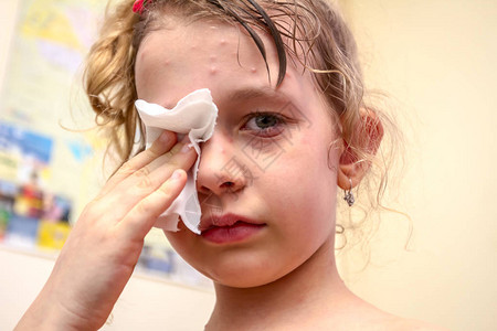 患有虫的悲伤女童的肖像有麻疹天花和风疹图片