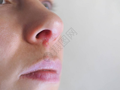 鼻子下面的疱疹特写图片
