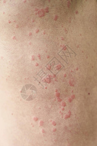 皮肤瑕疵皮肤过敏荨麻疹病皮肤上图片