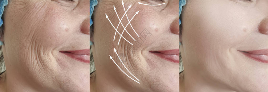 妇女的皱纹在治疗前后和治图片
