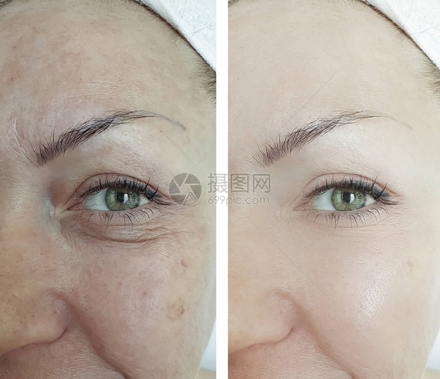 治疗前后的女人眼睛皱纹图片
