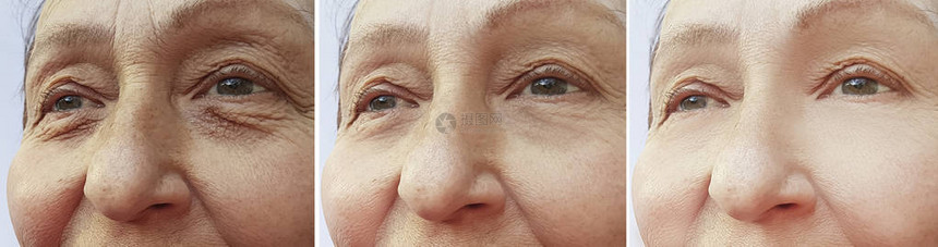 老年妇女在治疗前后的治疗前和治疗图片