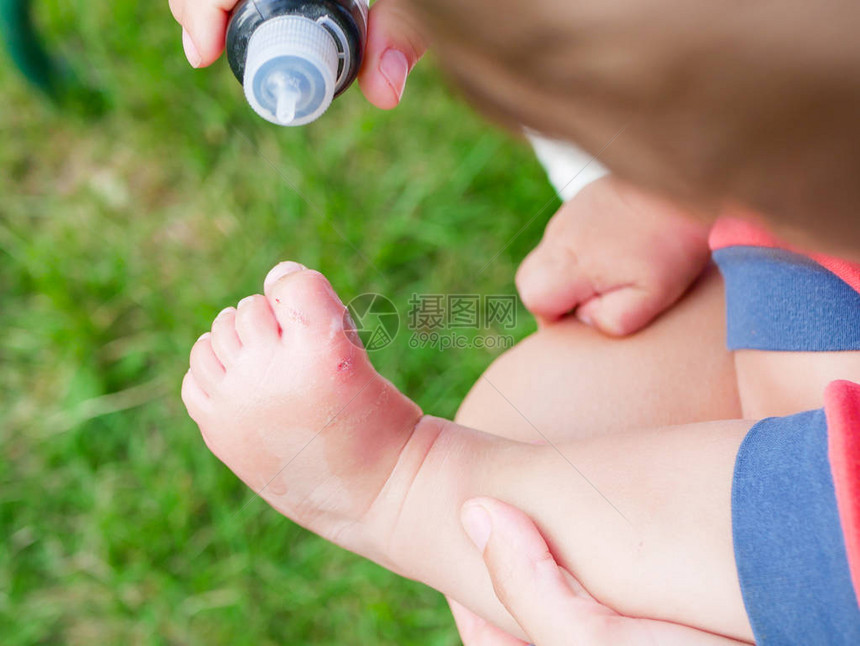 治疗孩子的伤口治疗小孩子的伤口孩子腿受伤图片