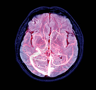 人头血管脑部的电磁共振脉动MRV可能是多次出血脑转移或出血的洞穴瘤图片