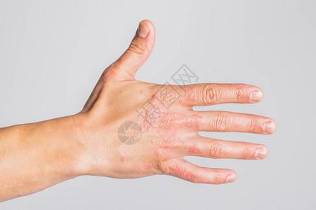 患有粗俗的牛皮癣湿疹和其他皮肤病背景图片