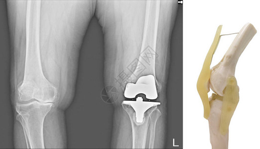 X射线两侧膝盖都显示出现退化骨髓炎OA膝关节失调背景图片