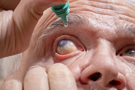 青光眼患者自行滴眼药水一位患有图片