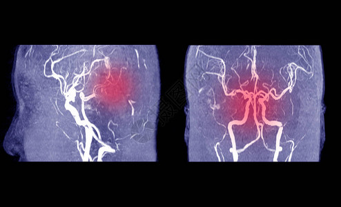 MRA脑或动脉磁共振血管造影与habd医生指出脑内血管异常医图片