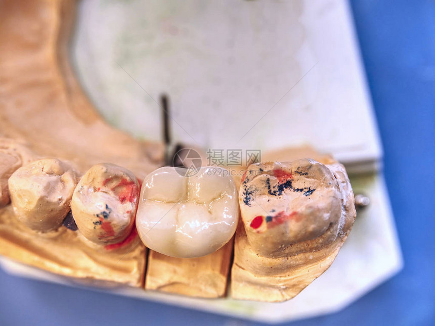 在牙科假牙实验室用固定假牙的JawJawJus图片