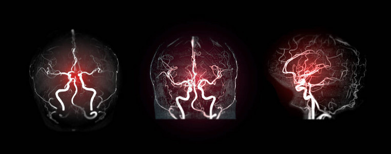 收集脑部动脉的MRA大脑或磁共振血管图像MRA图片